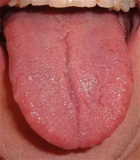 Tongue cancer symptoms | General center | SteadyHealth.com