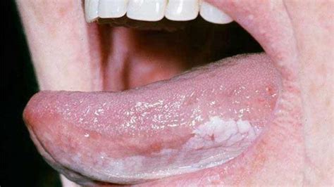 Tongue cancer: Symptoms, pictures, and outlook