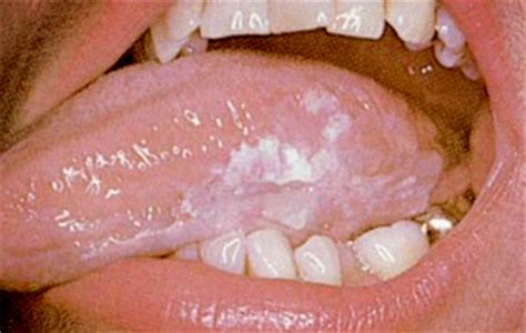 tongue cancer symptoms | Your Boca Dentist