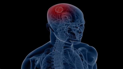 Top 6 symptoms of brain cancer.Be alert   YouTube