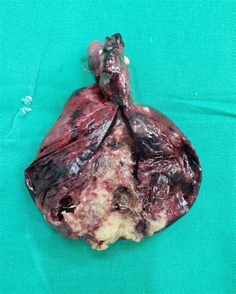 Torção de teratoma de ovário   Forum do Atlas Cirúrgico