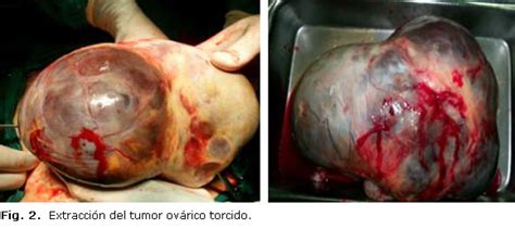 Torsión de tumor ovárico en paciente premenopáusica