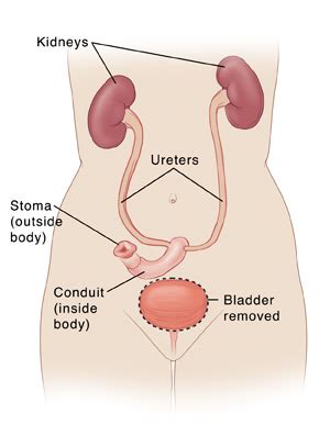 Total Cystectomy with Incontinent Urinary Diversion in Women