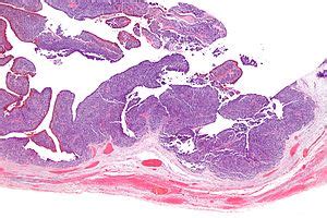 Transitional cell carcinoma of the ovary   Wikipedia