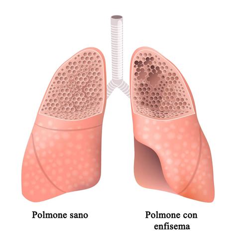 Trapianto di polmone: alcuni numeri interessanti