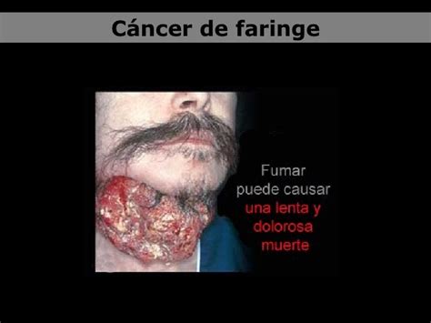 Tratamiento Cancer De Faringe