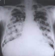 Tratamiento de cáncer de mama con metástasis a pulmón.