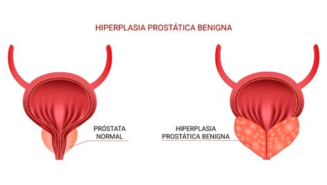 Tratamiento de la Hiperplasia Benigna de Próstata en Madrid