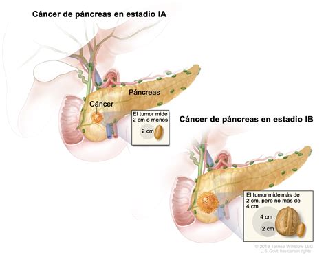 Tratamiento del cáncer de páncreas en adultos  PDQ ...