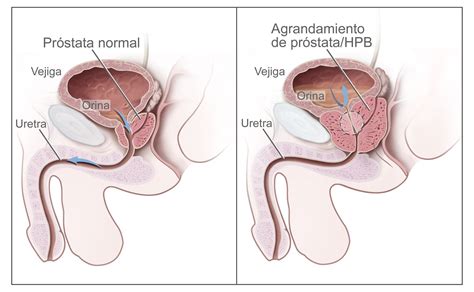 Tratamiento del cáncer de próstata  PDQ –Versión para pacientes ...