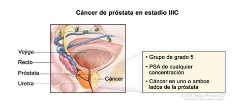 Tratamiento del cáncer de próstata  PDQ –Versión para pacientes   NCI