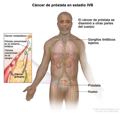 Tratamiento del cáncer de próstata  PDQ –Versión para pacientes   NCI