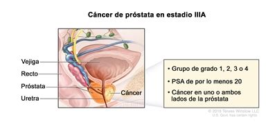 Tratamiento del cáncer de próstata  PDQ  : Tratamiento ...