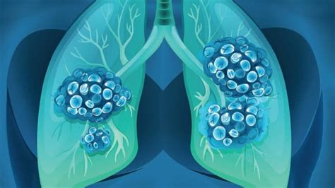 Tratamiento del cáncer de pulmón: Alternativo,quirúrgico ...
