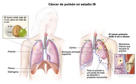 Tratamiento del cáncer de pulmón de células no pequeñas ...