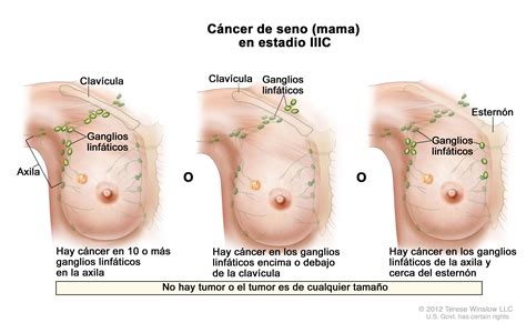 Tratamiento del cáncer de seno  mama   PDQ —Versión para ...