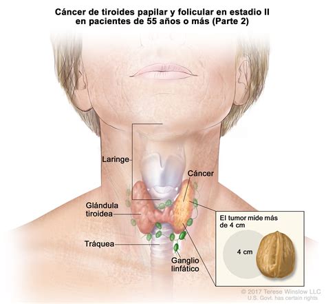 Tratamiento del cáncer de tiroides en adultos  PDQ ...