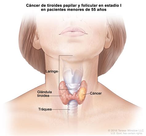 Tratamiento del cáncer de tiroides  PDQ —Versión para ...