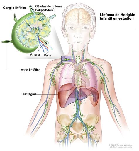 Tratamiento del linfoma de Hodgkin infantil  PDQ —Versión ...