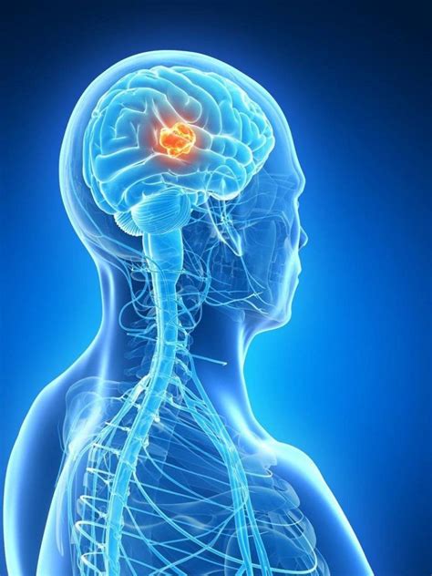 tratamiento del tumor en el cerebro: Todo lo que debes saber