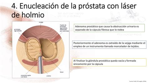 Tratamiento Quirúrgico en Hiperplasia Prostática Benigna   YouTube