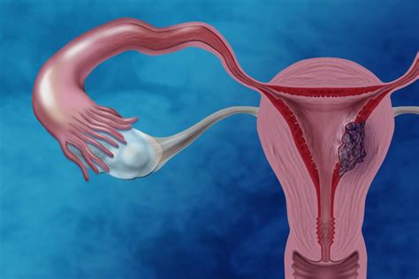Treating Endometrial Cancer without Radiation   National ...