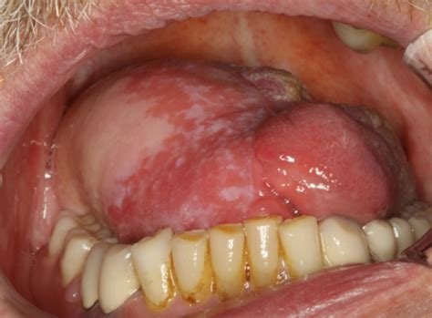 Treatment For Cancer: Treatment For Cancer At Base Of Tongue