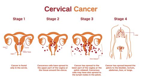 Treatment of Cervical Cancer, Homeopathy Speciality Cancer