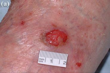 Treatment of invasive squamous cell carcinoma with 5 ...