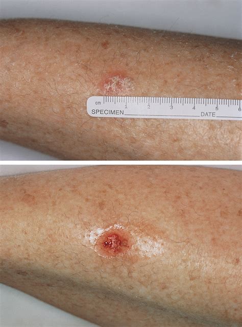 Treatment of Superficial Basal Cell Carcinoma and Squamous ...