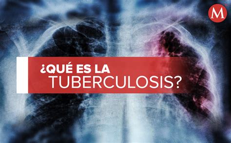 Tuberculosis. ¿Qué es, cuáles son sus síntomas y cómo se trata?