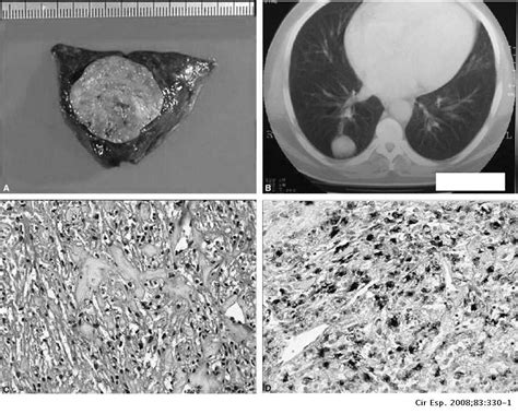 Tumor benigno de células claras de pulmón. Presentación de un caso y ...