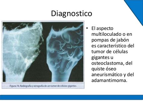 Tumor Benigno de Celulas Gigantes / Traumatolgoia y Ortopedia
