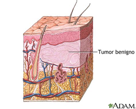 Tumor benigno de la piel: MedlinePlus enciclopedia médica illustración
