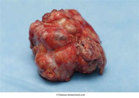 Tumor benigno de mama, sintomas, fibroadenoma, filoide, tipos