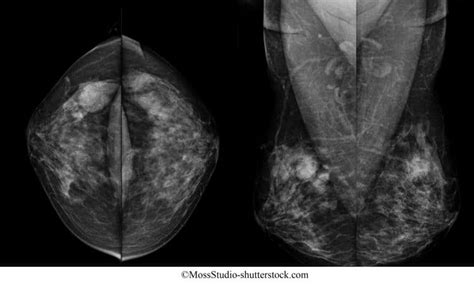 Tumor benigno de mama, síntomas, frecuente, tratamiento