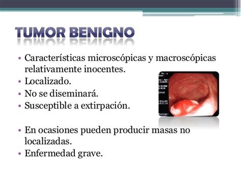 Tumor Benigno Definicion   SEO POSITIVO