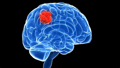 Tumor benigno en el cerebro: Qué es, síntomas, tratamiento ...