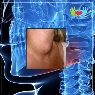 Tumor Benigno: Tiroides  Bocio    Cirugía 24 Horas