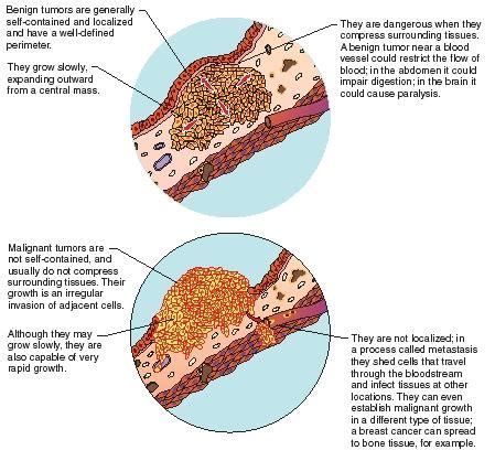 Tumor body, process, type, characteristics, cells ...