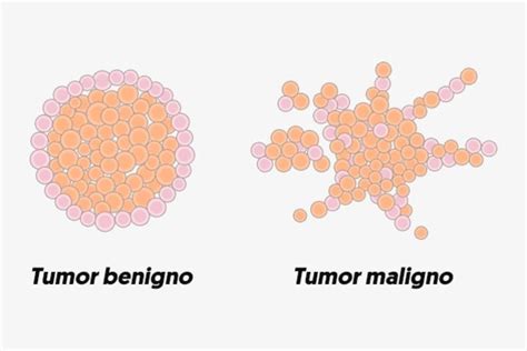 Tumor, câncer ou neoplasia: por que surgem e quais são malignos ou ...