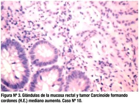 Tumor carcinoide del recto: correlación clínico patológica