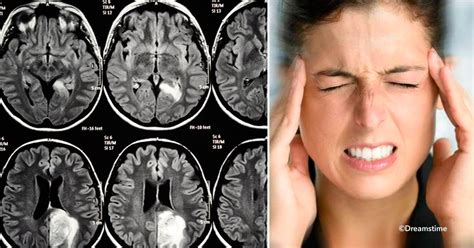 Tumor cerebral, 8 síntomas que alertan al cuerpo   Va a ...