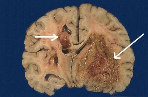 Tumor cerebral: aprenda a identificar os sintomas da ...