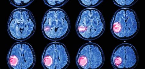 tumor cerebral Archivos | Centro de Información Médica ...