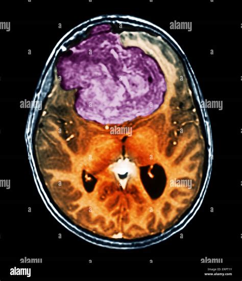 Tumor cerebral benigno. Color tomografía axial ...