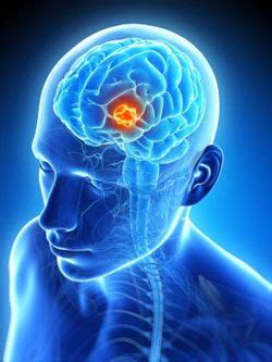 Tumor cerebral | Brain tumor, Brain tumor awareness, Brain ...