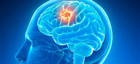 Tumor Cerebral | Causas, Síntomas y Tratamiento
