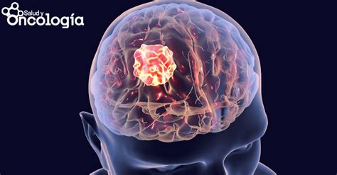 Tumor cerebral: condición que puede afectar funciones ...