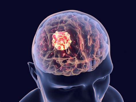 Tumor cerebral: condición que puede afectar funciones ...